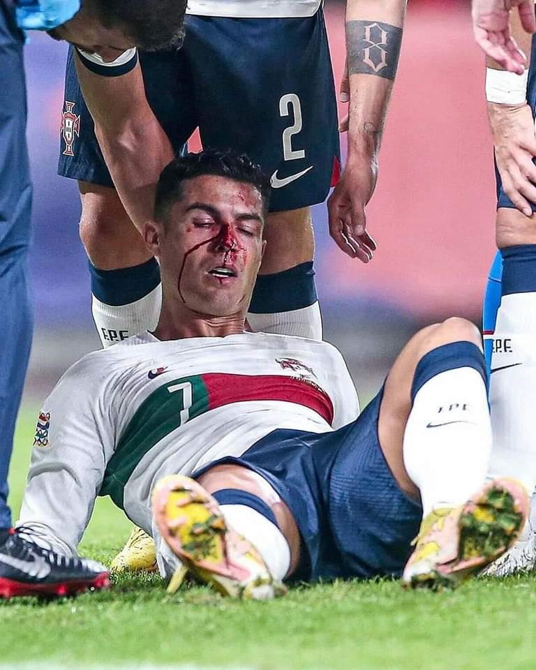 Chấn thương rợn người của Ronaldo