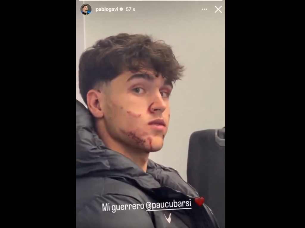 Cubarsi with 10 stitches on the face