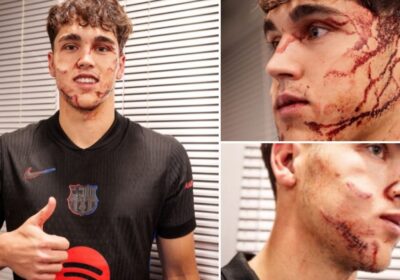 Barcelona Cubarsi with 10 stitches after Champions League horrific injury